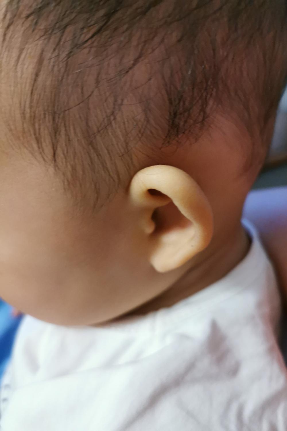 宝宝耳朵有点招风耳怎么办,新生儿睡觉耳朵招风耳可以矫正吗