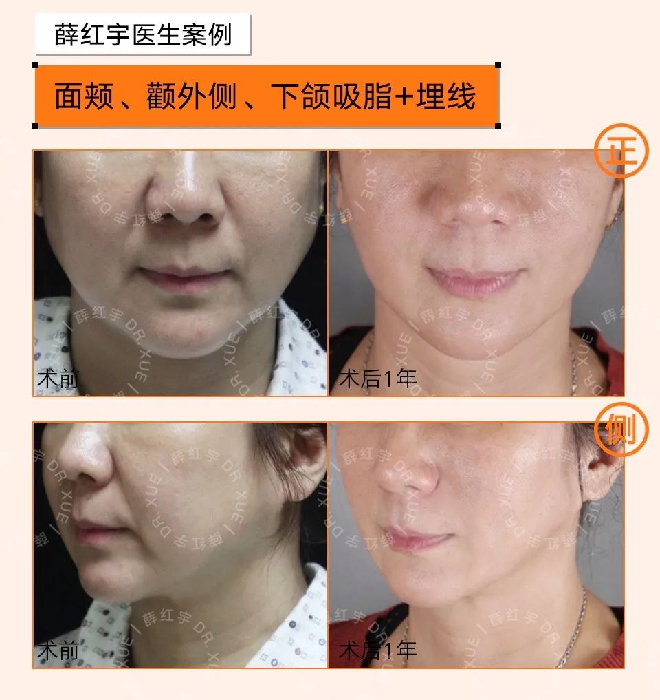 法令纹怎么改善脸部衰老,改善法令纹按摩手法视频