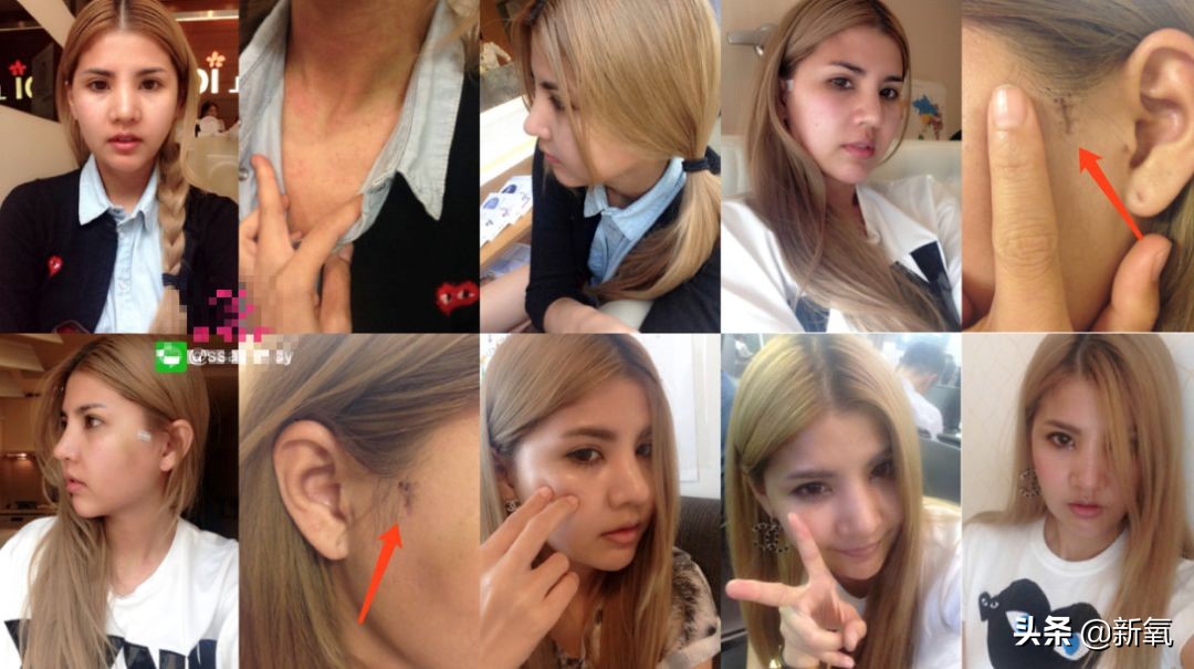 18岁土肥圆豪掷800万全身整形，鼻子6次大整假体穿出，效果却超美