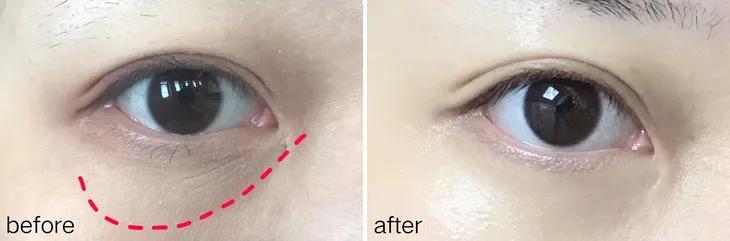 马应龙去除眼纹,马应龙去细纹