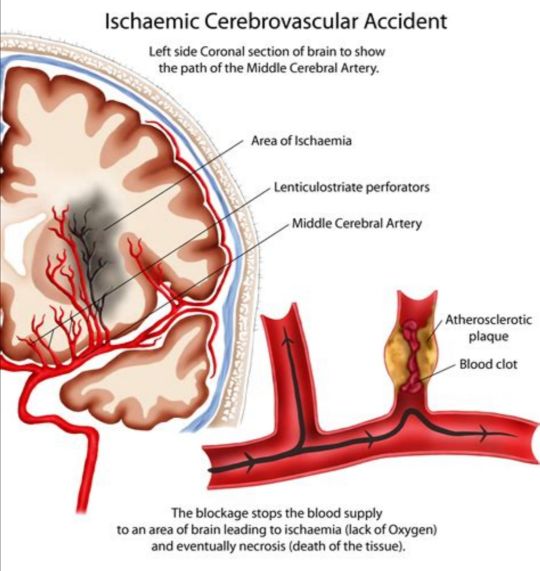 腔隙性脑梗死不吃降压药能治吗,腔隙性脑梗塞能活血吗