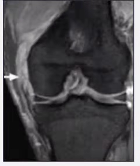 膝关节内侧副韧带损伤症状,膝关节副韧带损伤恢复训练