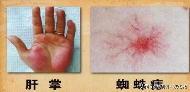 老公有乙肝大三阳还天天喝啤酒,老公有乙肝喝酒怎么办