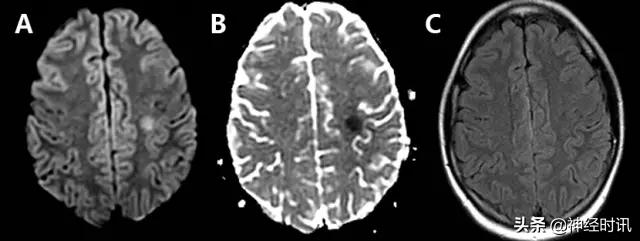 脑卒中病历诊断书图片,脑卒中影像判断技巧图解电子版