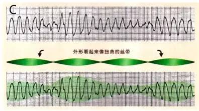 心律失常室性心动过速怎样造成的,室性心动过速最常见的病因