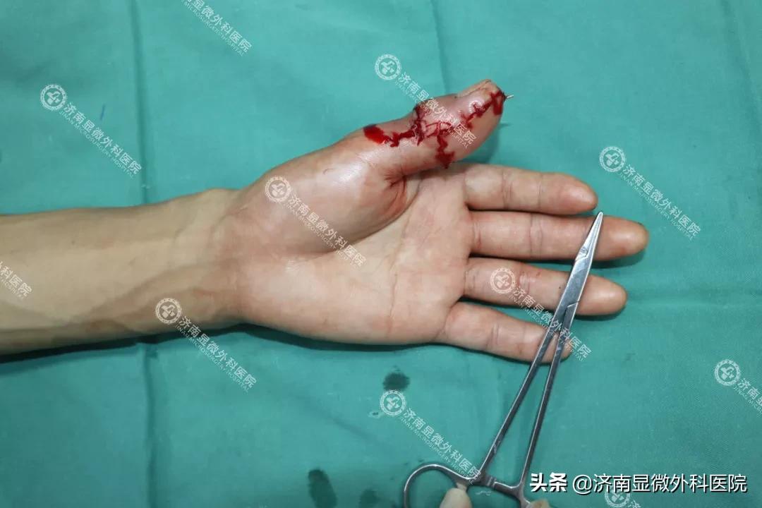 拇指缺失为什么影响这么大？手指再造中心如何找回缺失的手指？