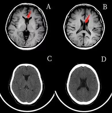 脑室透明隔间腔,第五脑室是什么意思
