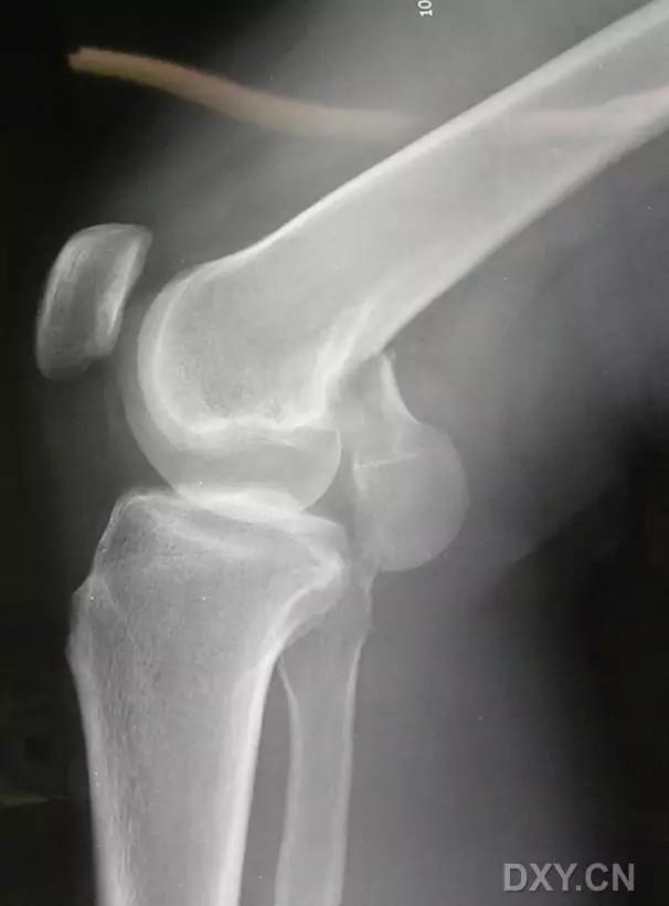 所有骨折都叫什么名字,骨折的名称有哪些