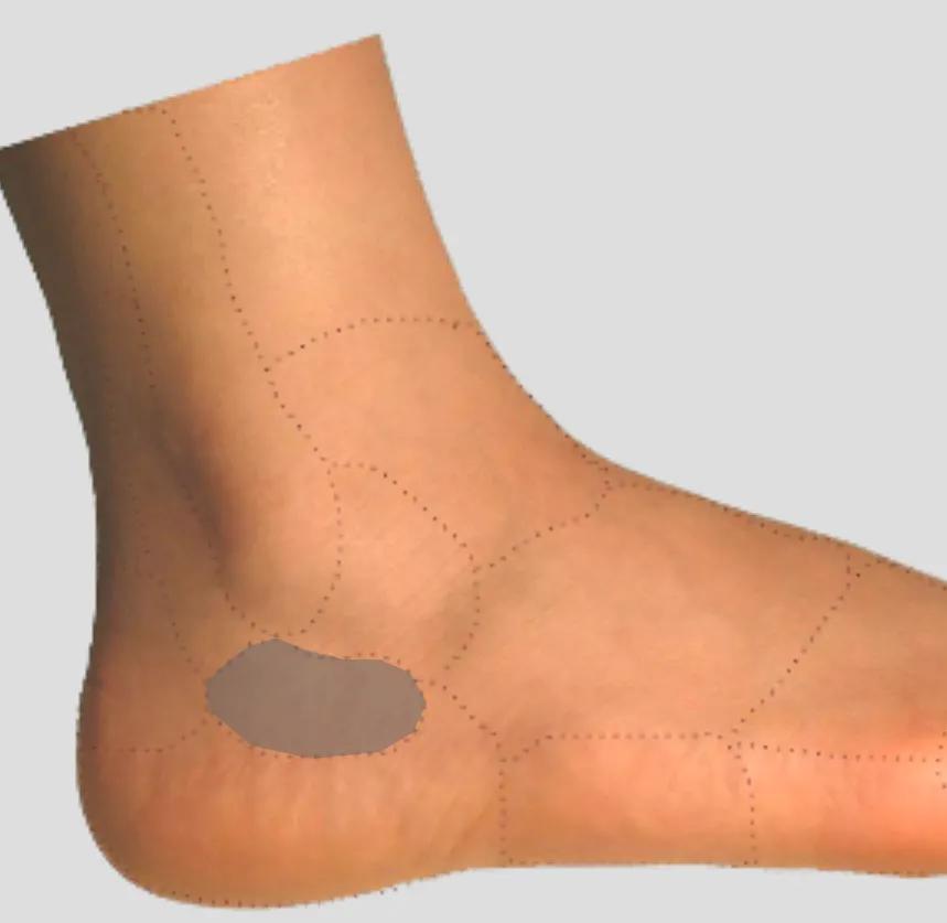 足踝各种疼痛的原因,足踝内侧疼痛自测