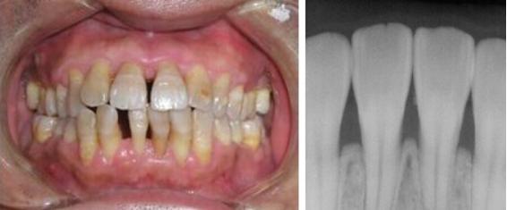 牙龈萎缩造成牙齿很松需要拔掉吗,牙龈萎缩严重导致牙齿掉