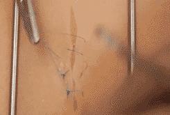 常用的手术缝合方法图,临床常见常用伤口缝合方法