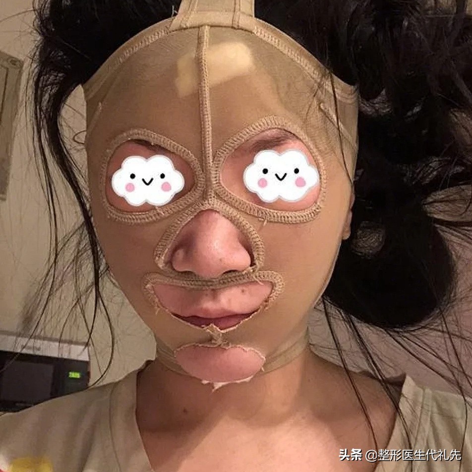 面部吸脂后会长痘痘吗,面部吸脂后皮下会长瘢痕吗