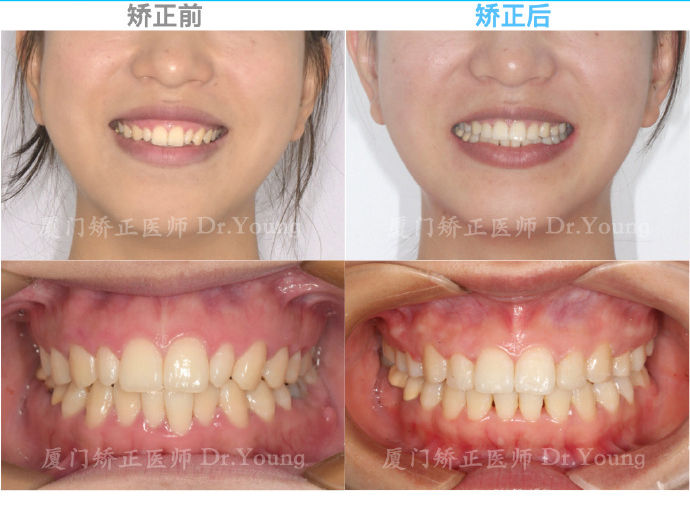 上颌前突下颌后缩是骨性还是牙性,厦门牙齿凸嘴矫正