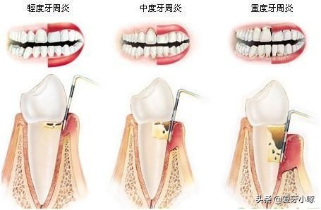 牙齿松动怎么办最快最有效的方法,牙齿松动怎么挽救