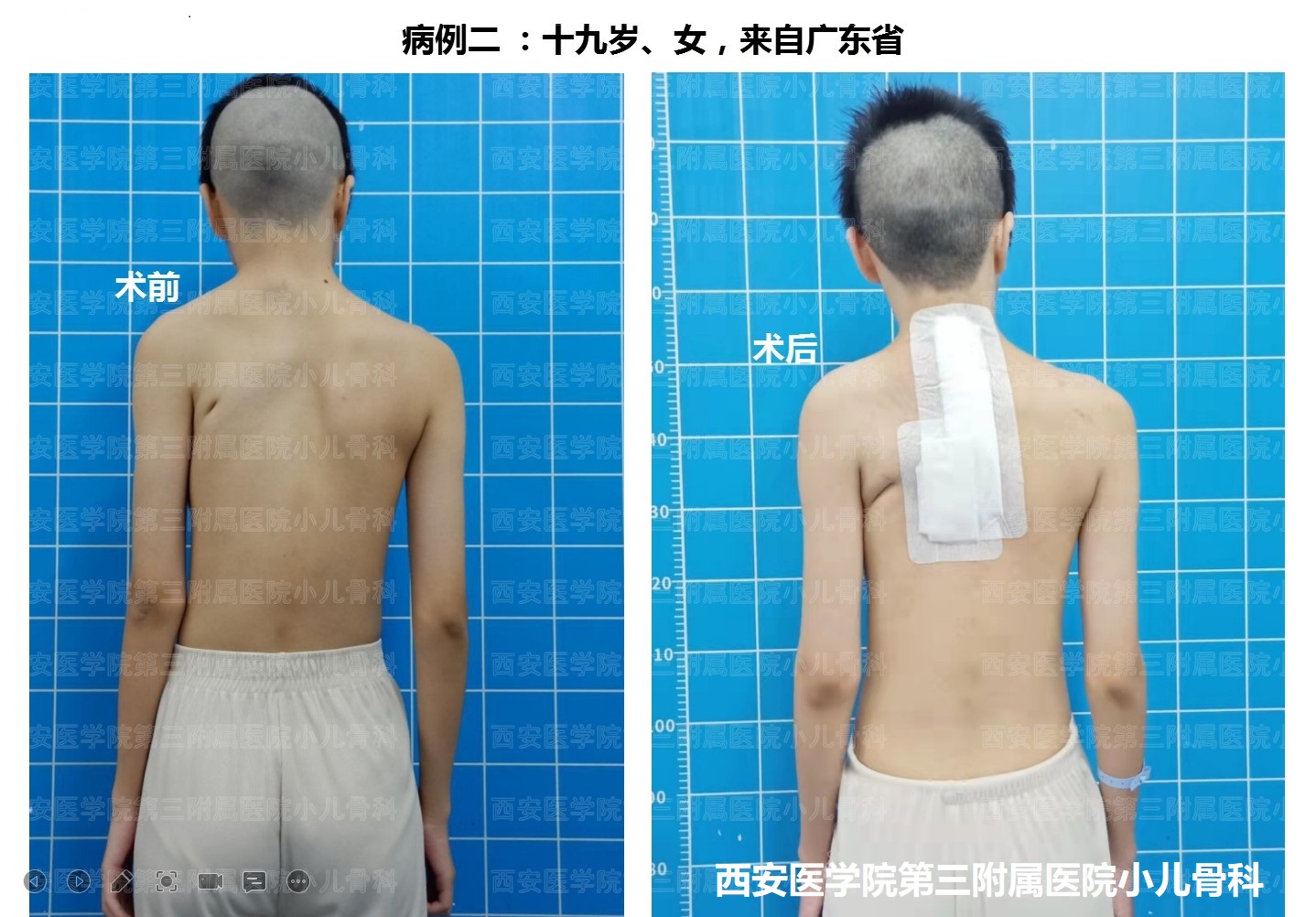 先天性高肩胛手术,先天性肩胛症通过手术需要多少钱