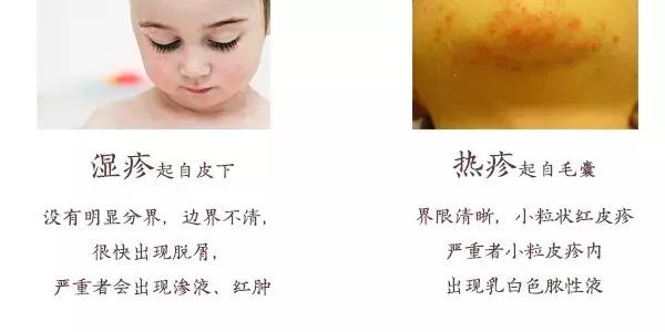 外阴湿疹用祛湿止痒软膏,专治儿童湿疹止痒特效药