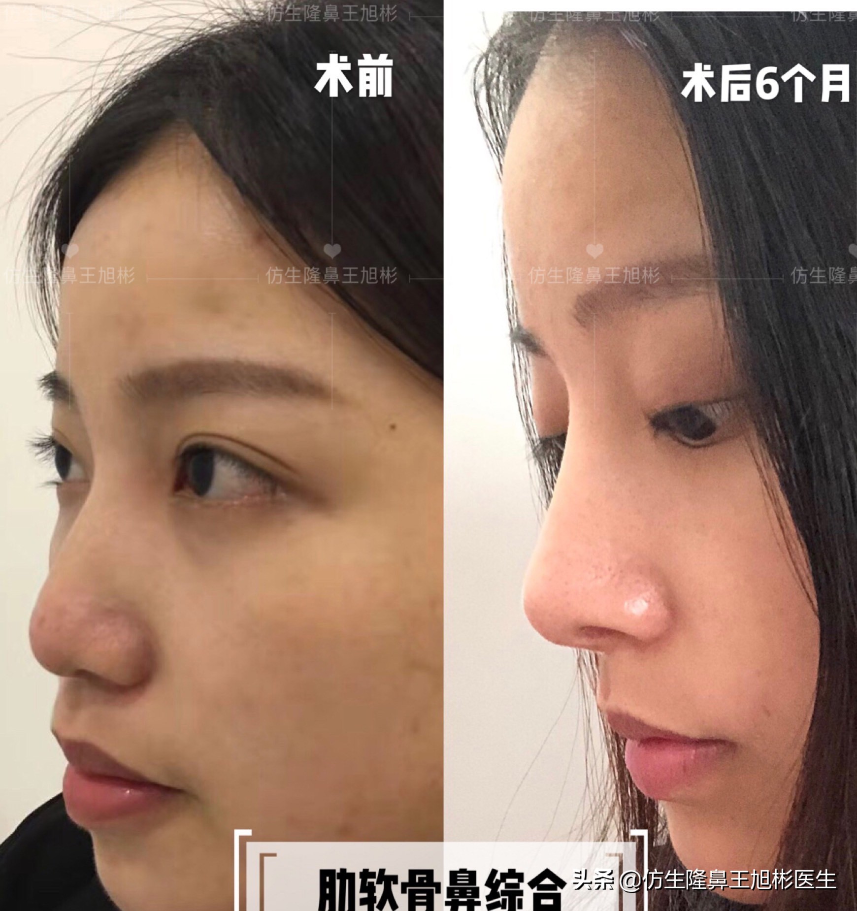 手术鼻头增厚能用什么方法弄,大鼻头高鼻梁缩小手术案例