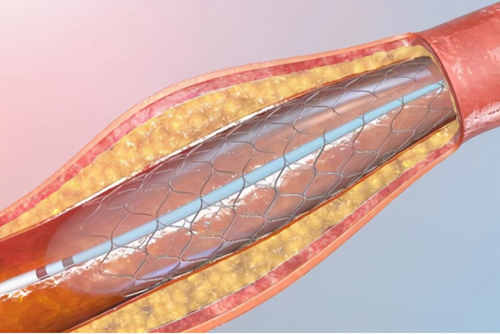 一个心脏支架的成本,支架种植牙多少钱一颗