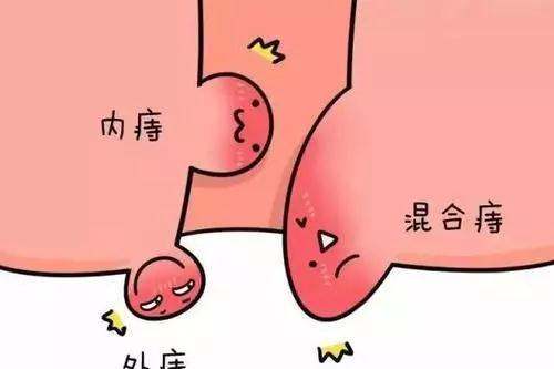 东大肛肠医院100元治痔疮是真的吗,北京东大肛肠医院痔疮药