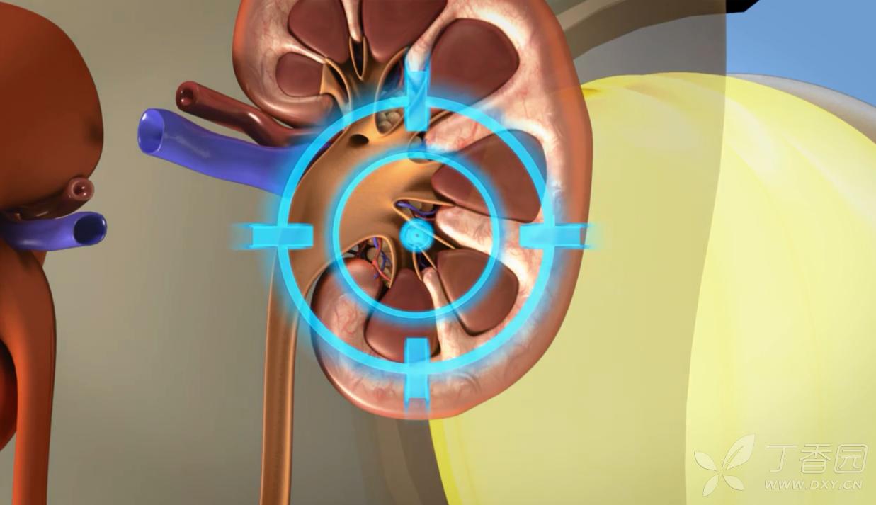 体外碎石做了三次肾结石又复发了,碎石三次了还没排出怎么回事