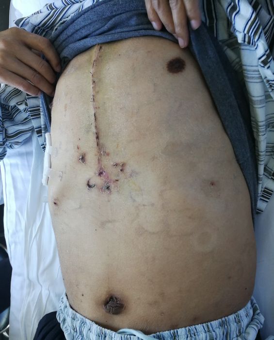 肺动脉血栓栓塞引起的肺高压,慢性血栓性肺动脉高压吃什么中药