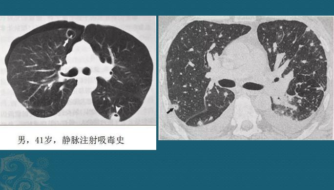 化脓性细菌感染用什么抗生素,化脓性细菌感染有痰用什么抗生素