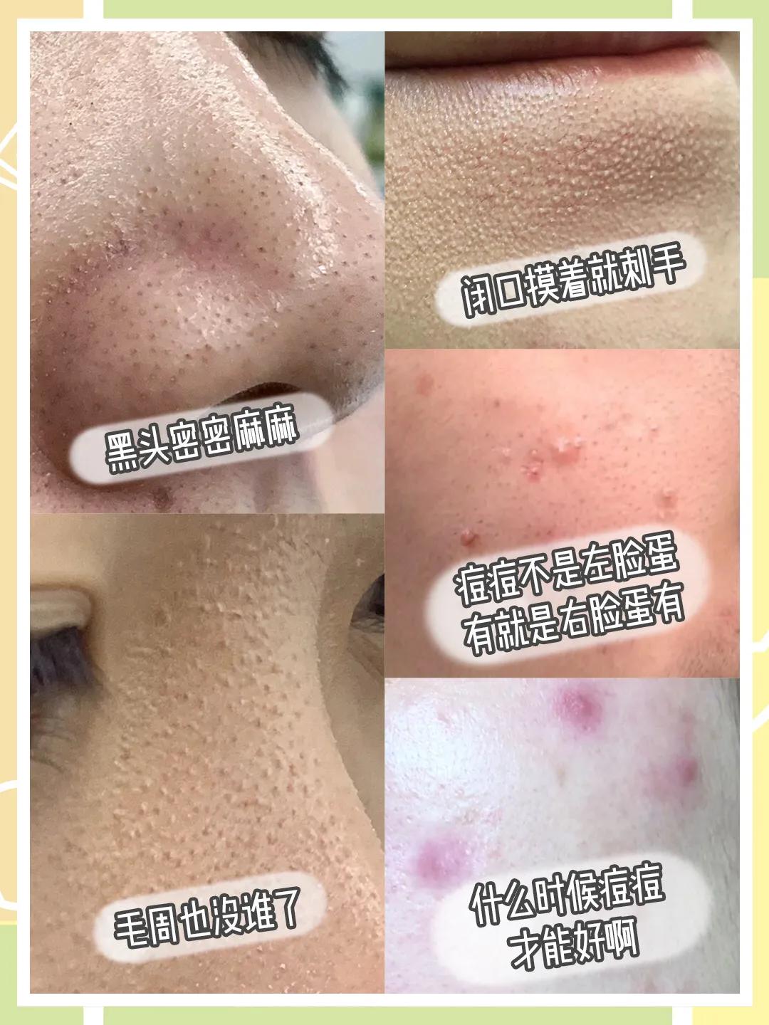 脸蛋两侧长了许多黑头是什么原因,脸蛋年轻貌美