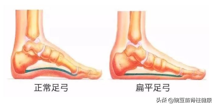 小孩矫正驼背的健身动作,纠正孩子走路驼背的锻炼方法