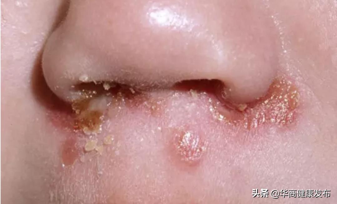 传染性的脓包痘痘,传染性脓疱疮的最快解决办法