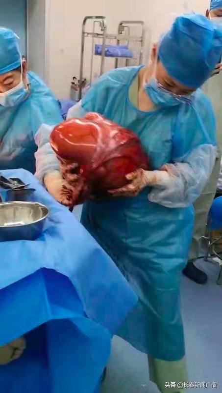 巨大肿瘤被医生成功切除,27岁女子巨大肿瘤切除手术