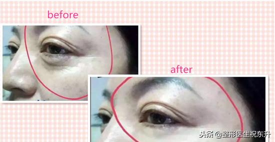 刚做完超声刀感觉脸有点肿正常吗,做完超声刀后脸肿了是正常现象吗