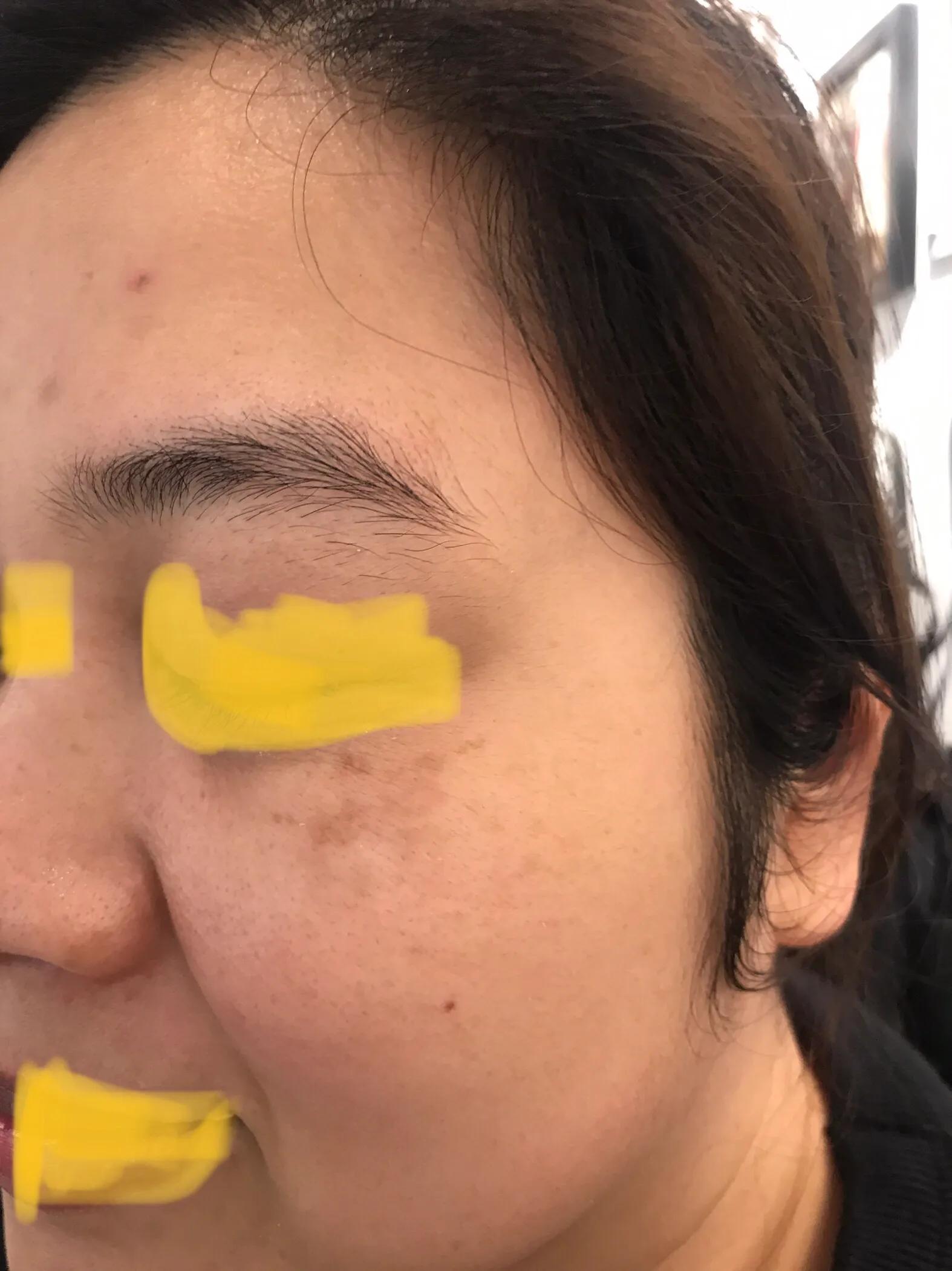 激光祛斑后斑片更大更黑了怎么办,两次祛斑还是反黑