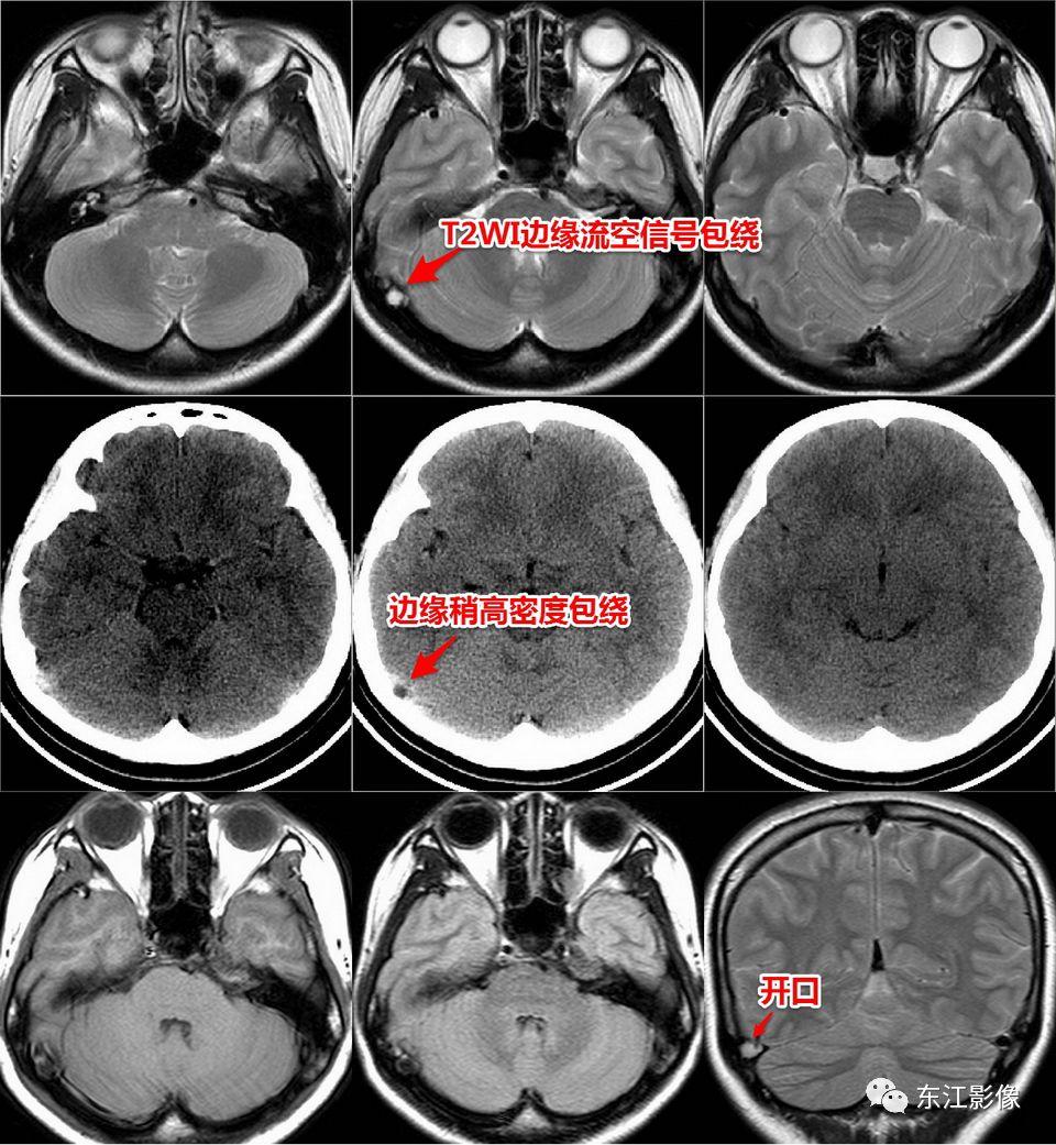 头颅mri扫描影像哪里找,头颅影像mra详细解说