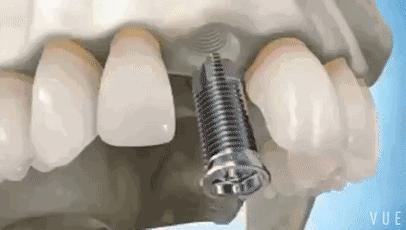 医生说我少一颗牙怎么回事,医生说我少了一颗牙