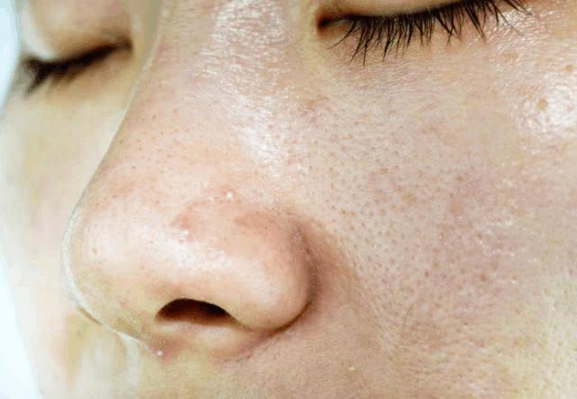 收缩毛孔最有效的方法真的有吗,收缩毛孔最省钱的方法