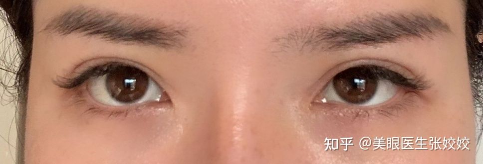 埋线双眼皮两边不对称怎么办,埋线双眼皮不对称修复方法