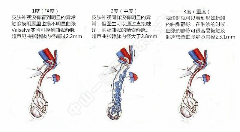 米诺地尔静脉曲张,麦滋林治疗静脉曲张