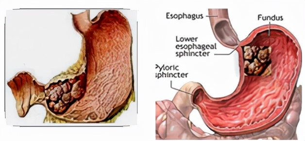 我不是药神，我不是财迷！若患胃癌，这些靶向药你有能力负担吗？