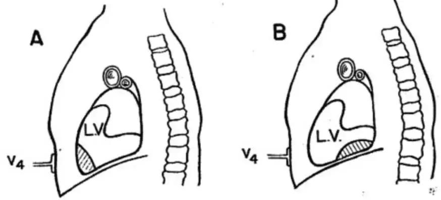心电图和心脏彩超以哪个为准,心电图和心脏超声是一样吗