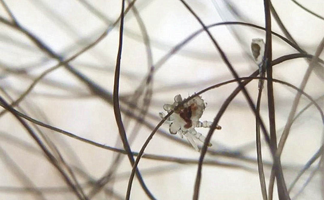 女子眼睛瘙痒难耐，医生从睫毛夹出17只阴虱！是怎么染上的？