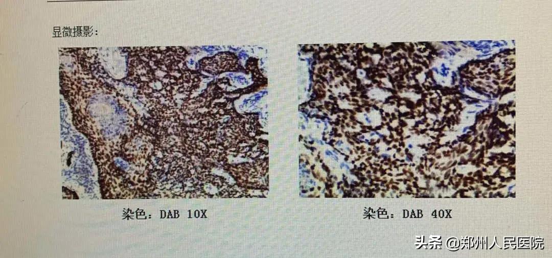 五十岁大叔抠痣抢救,男子抠痣后癌变