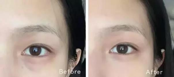 为什么眼睛大会显老？黑眼圈、眼袋、眼纹怎么去除？这两招就够了