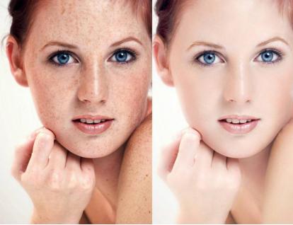 叙美雅祛斑会使角质层变薄吗,叙美雅祛斑小知识