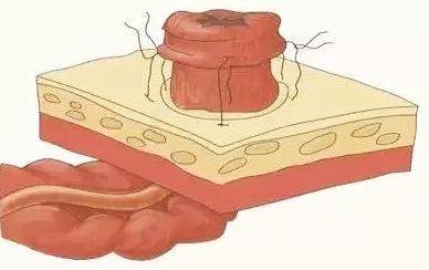 中国100万造口人：改道的肠子，改变的人生