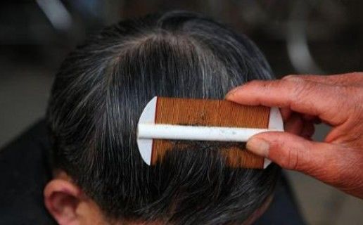 现在人虱子灭绝了吗,几十年前的农村几乎身上都有虱子