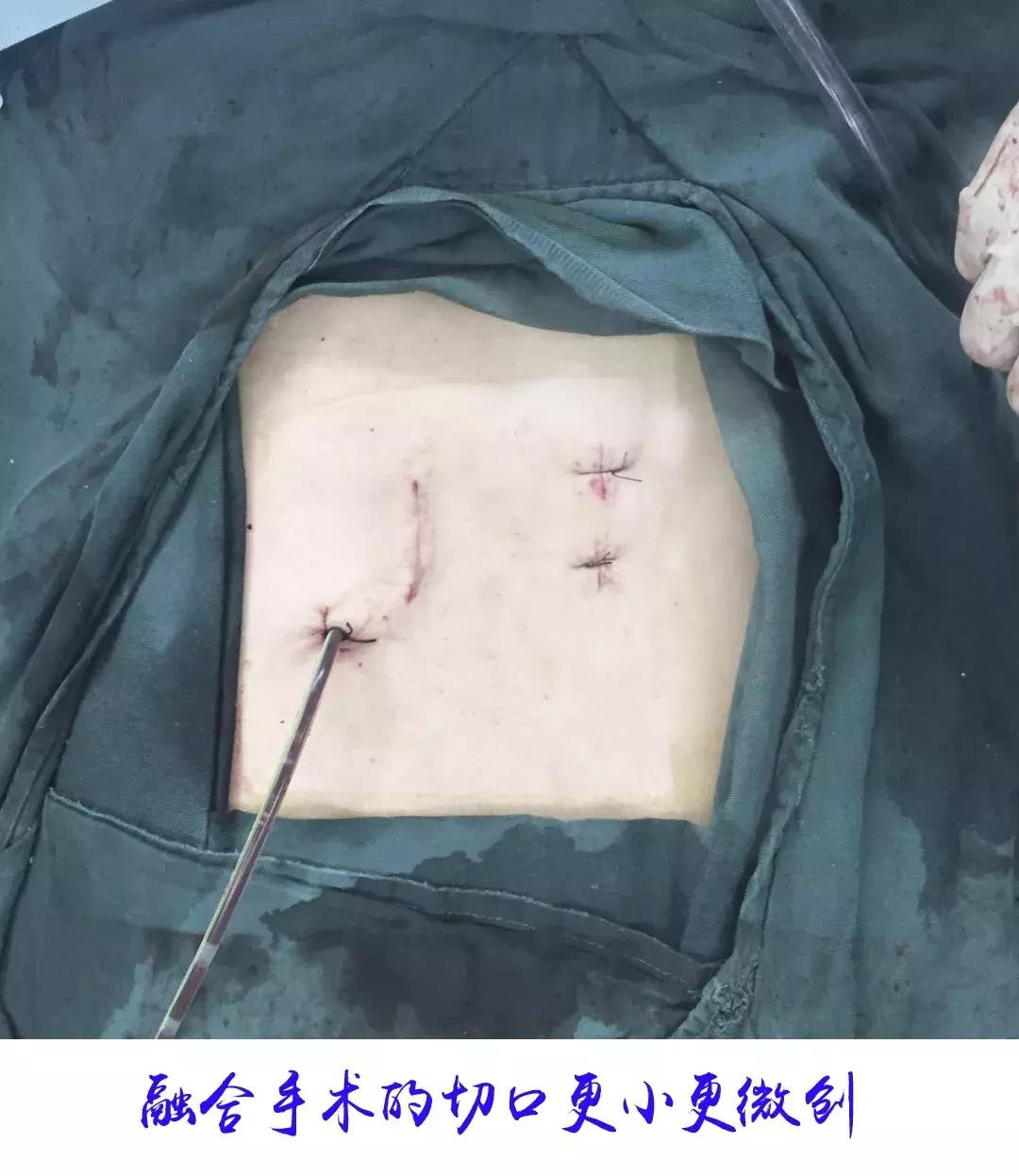 什么人适合微创手术治疗腰突,可视放射性治疗腰突效果怎么样