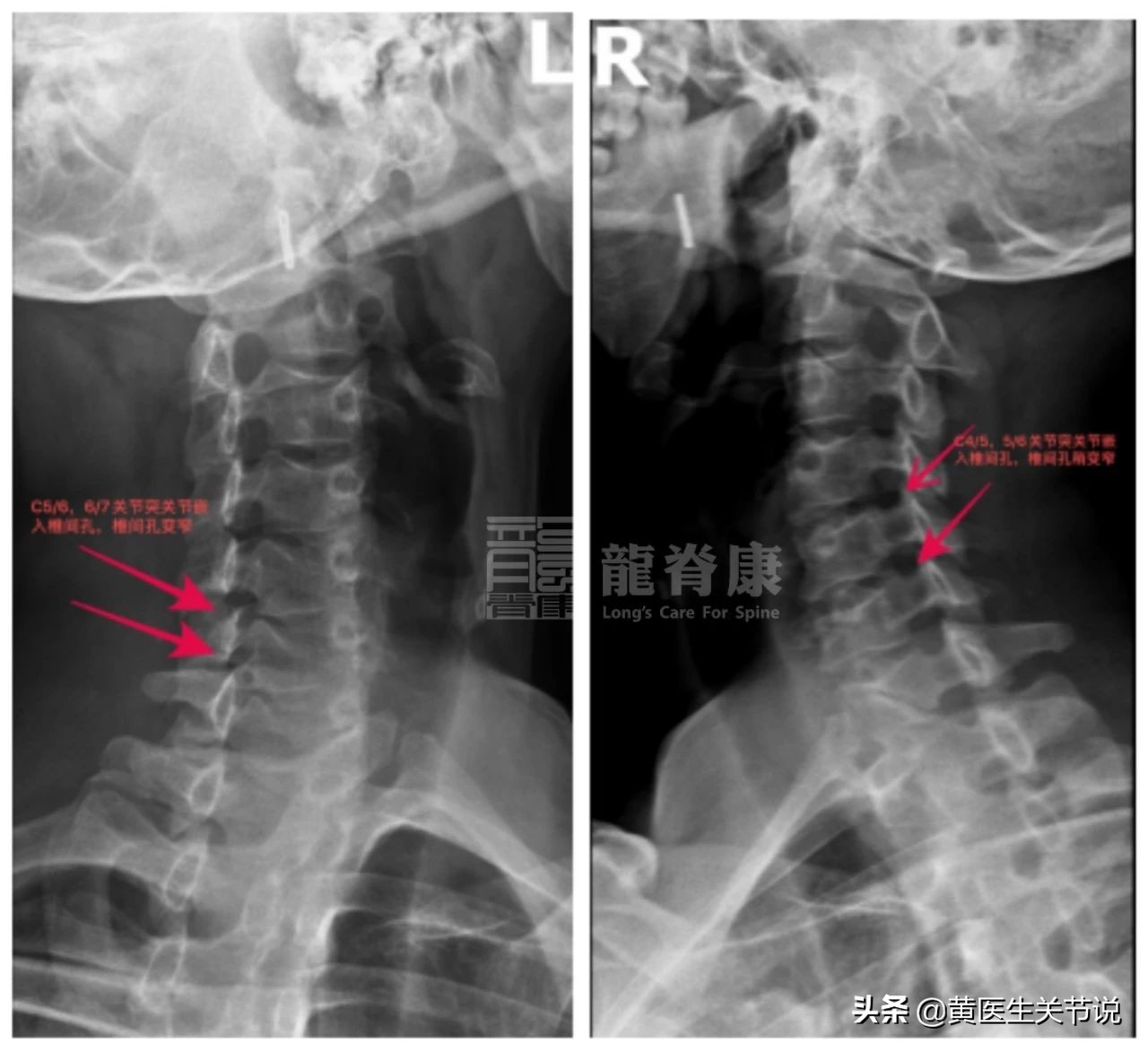 颈椎间盘突出什么情况需要手术,颈椎间盘突出硬膜囊受压手术费用