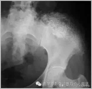 软组织钙化是不是骨化性肌炎,软组织钙化或骨化