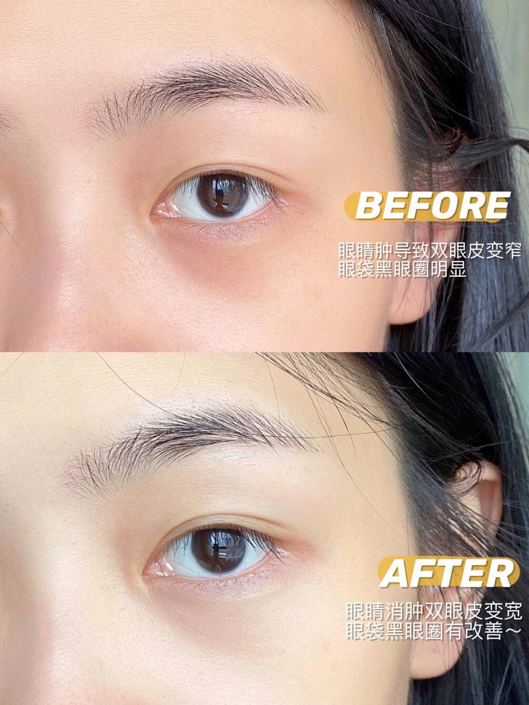 眼周水肿的原因分析,如何改善眼皮浮肿