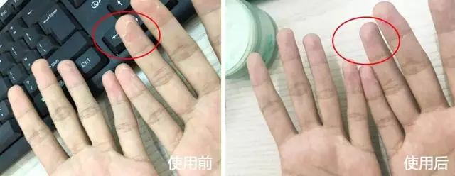 夏天了手脚干裂还有老茧,手脚干裂脱皮老茧用什么药膏